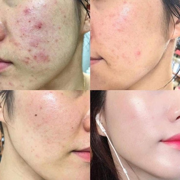 Trị Mụn Xong Bị Thâm – Sẹo: Cách Làm Mờ Và Phục Hồi
